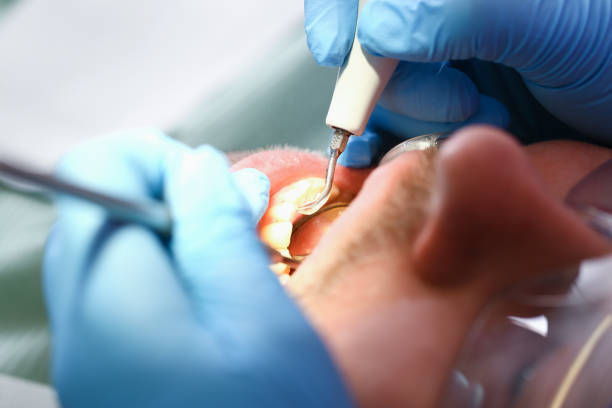 Best Emergency Root Canal Therapy in Bella Vista, CA